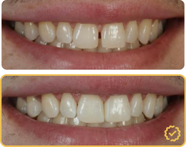 Composite bonding before and after — chipped front teeth restored with hand-layered composite resin in Manchester
