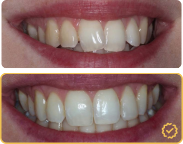 Composite bonding before and after — gaps closed and smile line reshaped at Gartside Street Dental Lounge, Spinningfields