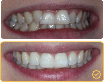 Composite bonding before and after — worn edges rebuilt and shade matched on a Manchester patient
