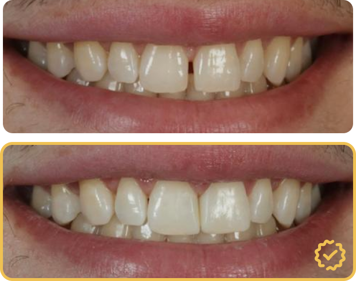 Invisalign Before After Comparison