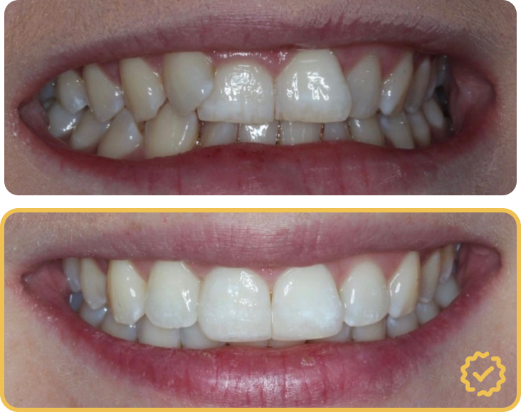 Invisalign Before After Comparison